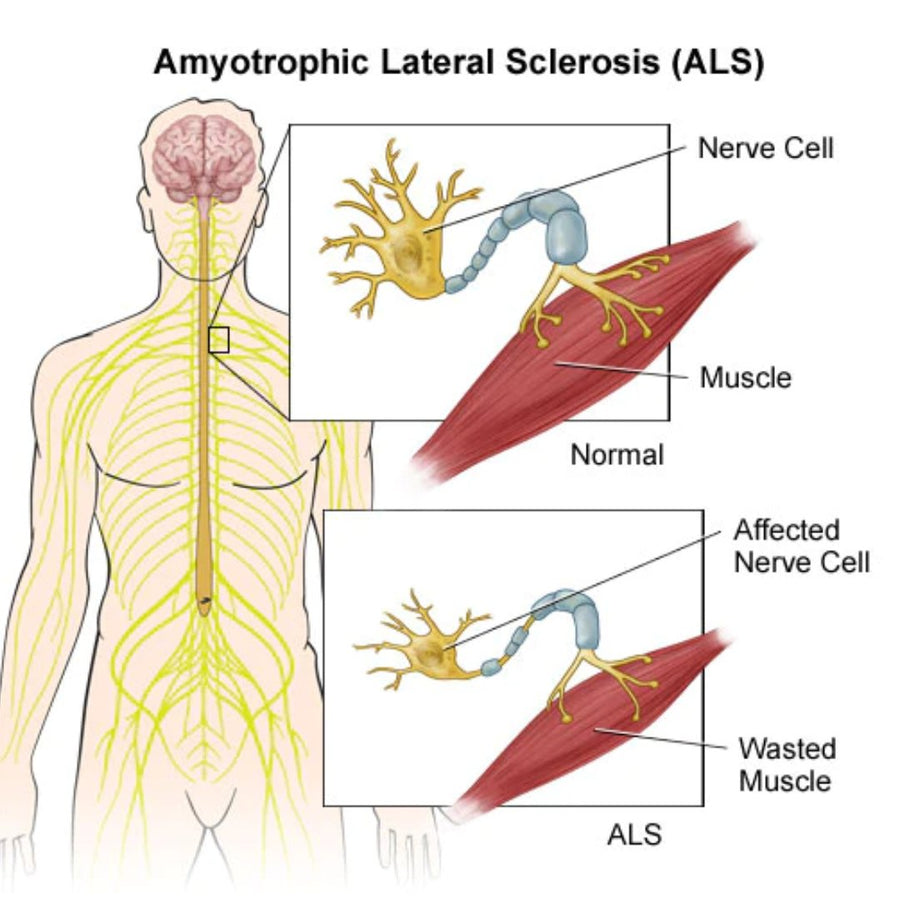 ALS - Lou Gehrig’s Disease